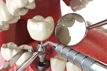 Implanty zębowe – psychologiczne aspekty ich wyboru