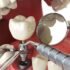 Implanty zębowe – psychologiczne aspekty ich wyboru